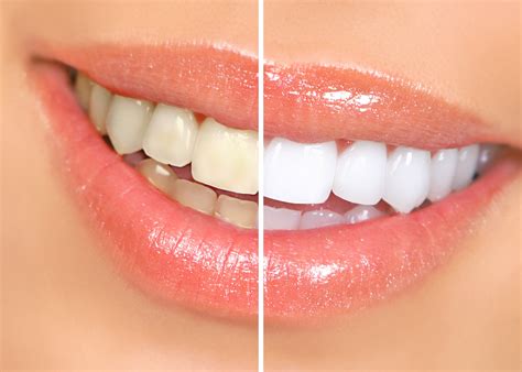 Magic natural teeth whitneing